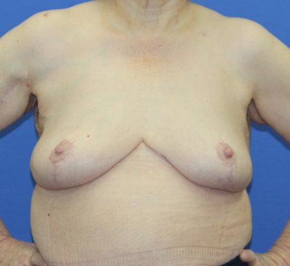 Breast Reduction Before & After Patient #2809