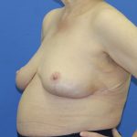 Breast Reduction Before & After Patient #2809