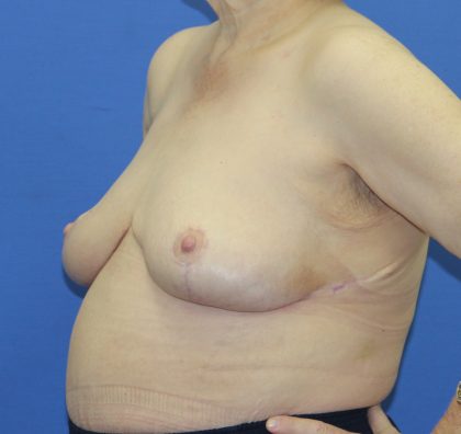 Breast Reduction Before & After Patient #2809
