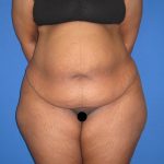 Tummy Tuck Before & After Patient #3213