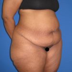 Tummy Tuck Before & After Patient #3213