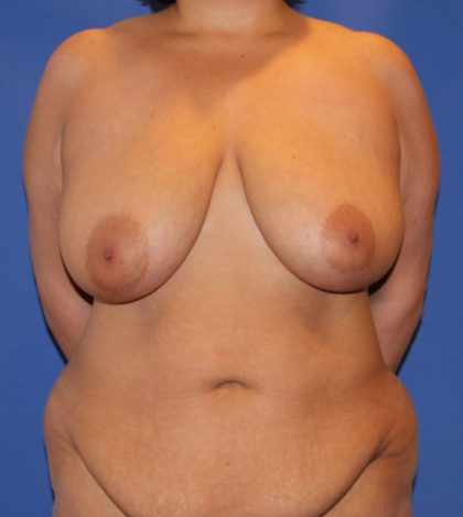 Breast Reduction Before & After Patient #2818