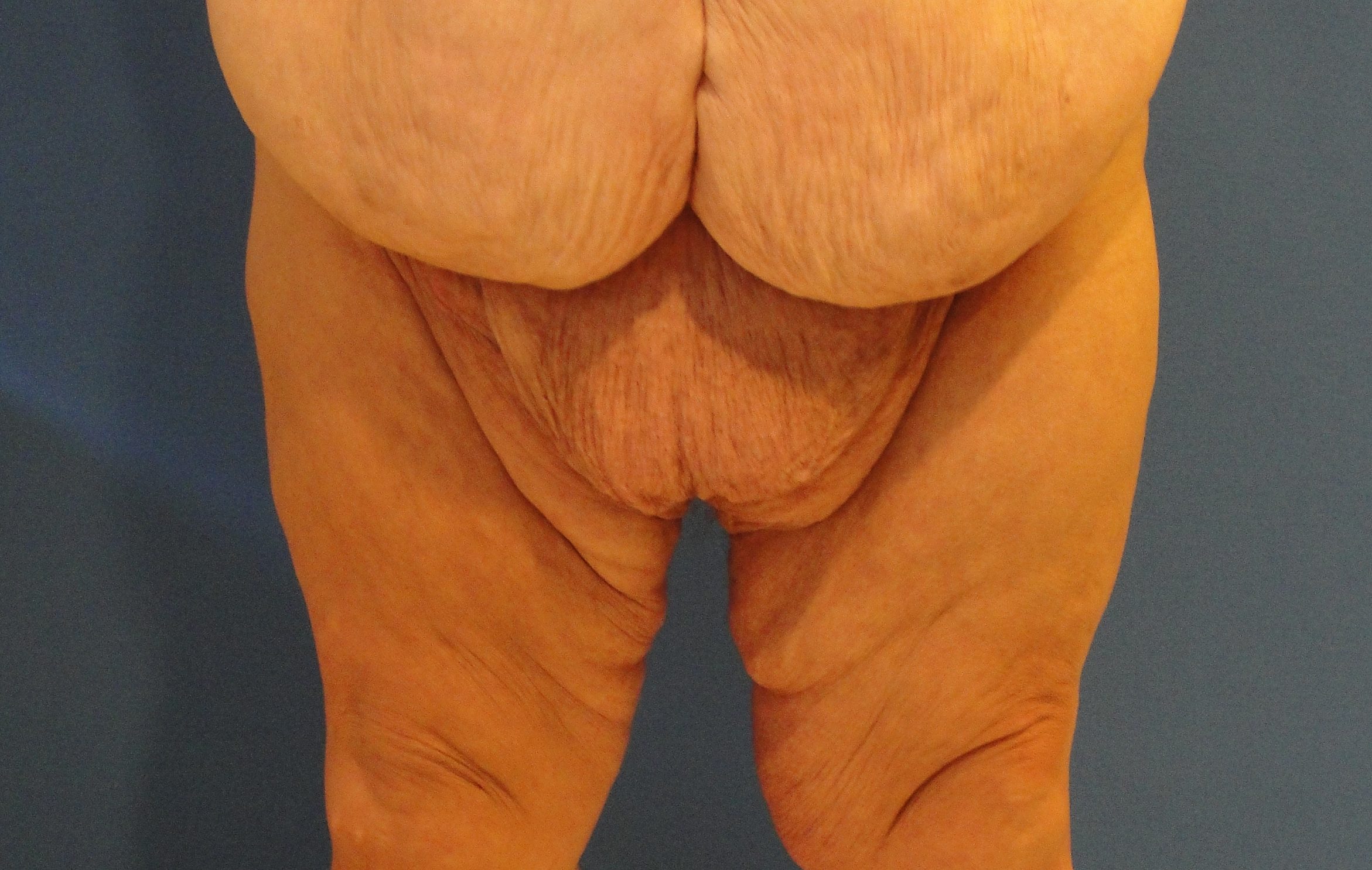 Mons Rejuvenation Before & After Patient #4130