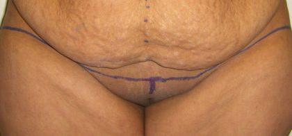 Mons Pubis Reduction Cosmetic surgeon in Pimpri Chinchwad, Pune