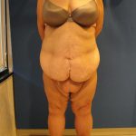 Panniculectomy Before & After Patient #4149