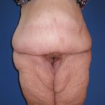 Panniculectomy Before & After Patient #4150