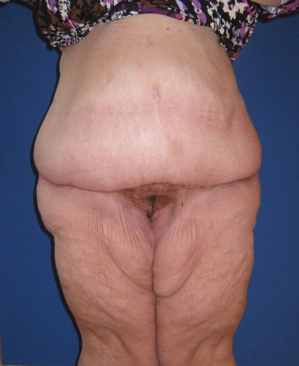 Panniculectomy Before & After Patient #4150