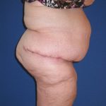 Panniculectomy Before & After Patient #4150