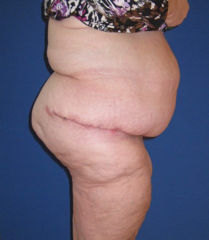 Panniculectomy Before & After Patient #4150