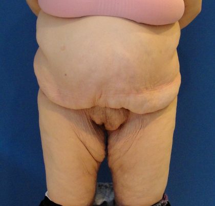 Panniculectomy Before & After Patient #4155