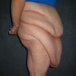 Panniculectomy Before & After Patient #4155