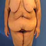 Panniculectomy Before & After Patient #4160