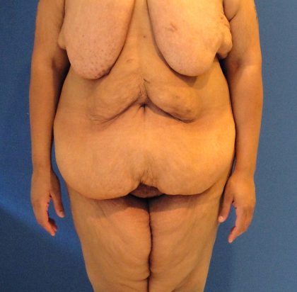 Panniculectomy Before & After Patient #4160