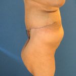 Panniculectomy Before & After Patient #4160