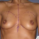 Breast Augmentation Before & After Patient #2721