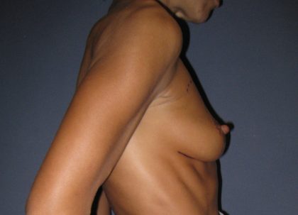 Breast Augmentation Before & After Patient #2721