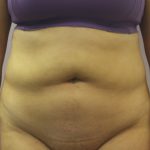 Liposuction Before & After Patient #4048