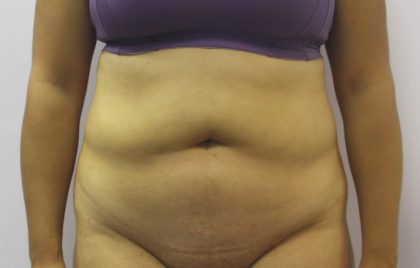 Liposuction Before & After Patient #4048