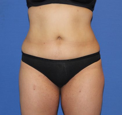 Liposuction Before & After Patient #4048