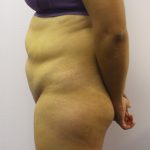 Liposuction Before & After Patient #4048