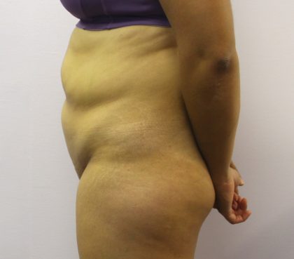 Liposuction Before & After Patient #4048