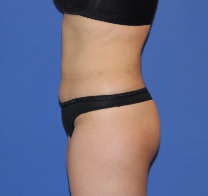 Liposuction Before & After Patient #4048