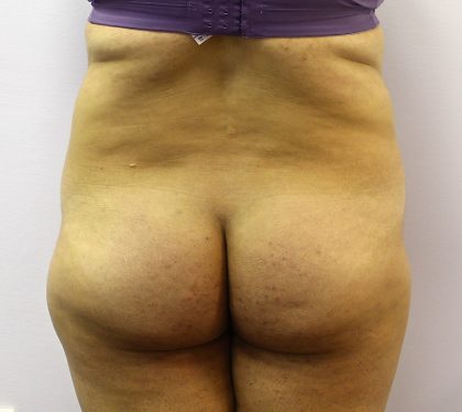 Liposuction Before & After Patient #4048