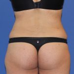 Liposuction Before & After Patient #4048