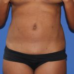 Liposuction Before & After Patient #4055