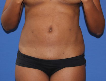 Liposuction Before & After Patient #4055