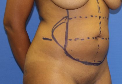 Liposuction Before & After Patient #4055