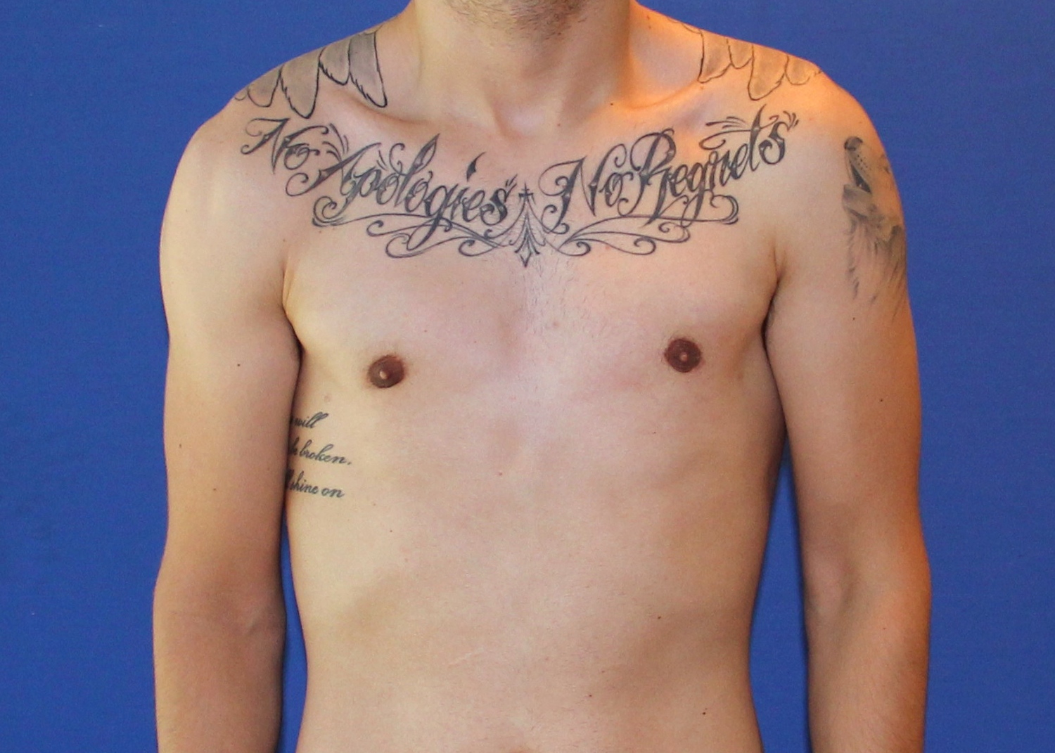 Liposuction Before & After Patient #4071