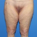 Thigh Lift Before & After Patient #4165