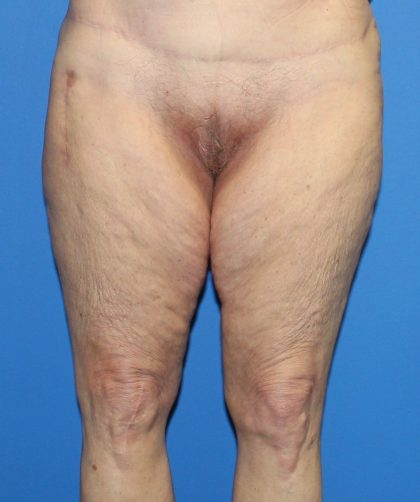 Thigh Lift Before & After Patient #4165