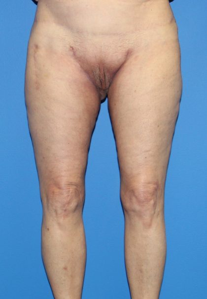 Thigh Lift Before & After Patient #4165