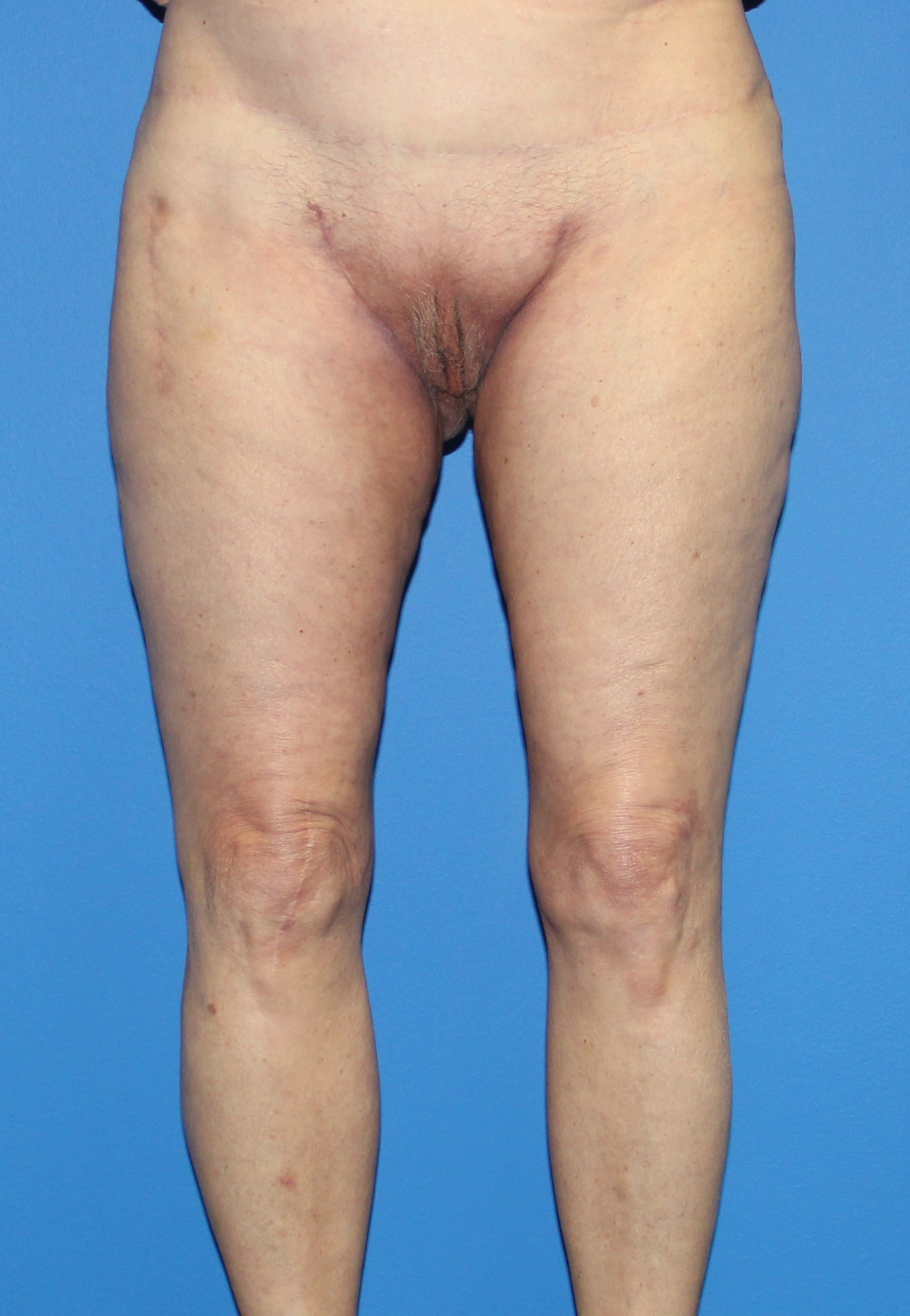 Thigh Lift Before & After Patient #4165