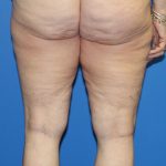 Thigh Lift Before & After Patient #4165