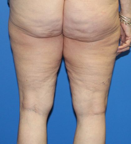 Thigh Lift Before & After Patient #4165