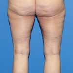 Thigh Lift Before & After Patient #4165