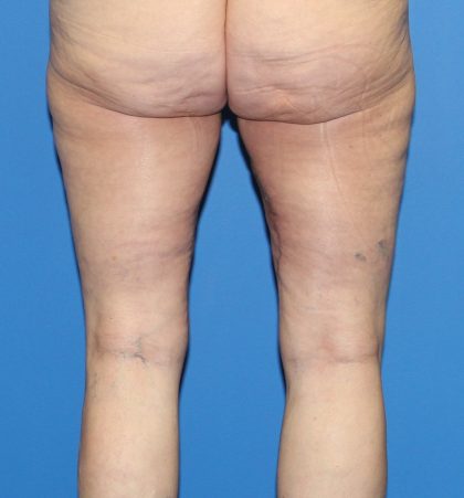 Thigh Lift Before & After Patient #4165