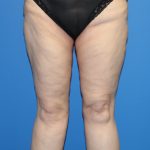 Thigh Lift Before & After Patient #4202
