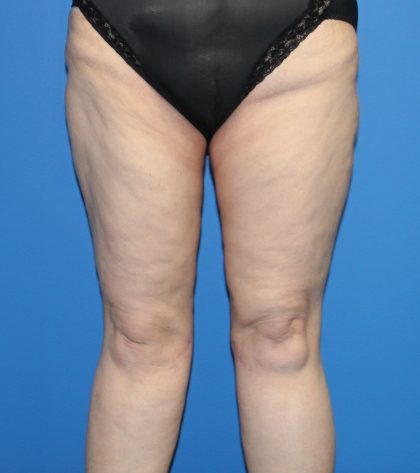 Thigh Lift Before & After Patient #4202