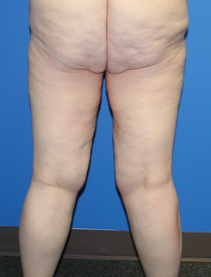 Thigh Lift Before & After Patient #4202