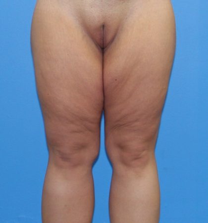 Thigh Lift Before & After Patient #4170