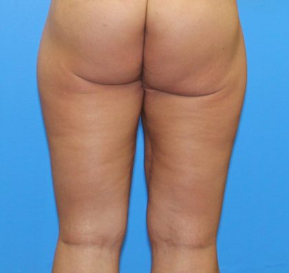 Thigh Lift Before & After Patient #4170