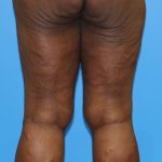 Thigh Lift Before & After Patient #4175