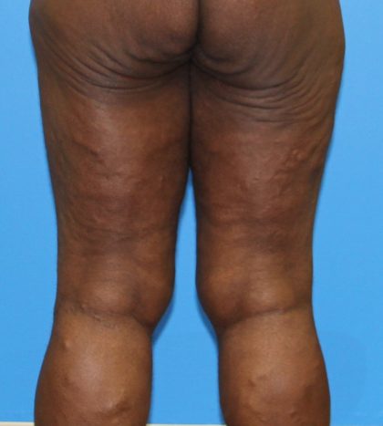 Thigh Lift Before & After Patient #4175