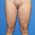 Thigh Lift Before & After Patient #4180