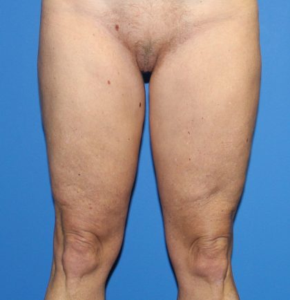 Thigh Lift Before & After Patient #4180