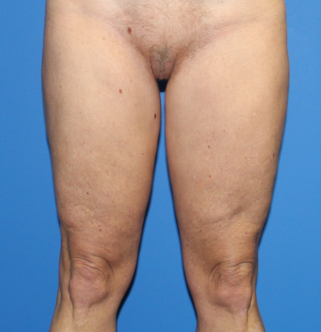 Thigh Lift Before & After Patient #4180